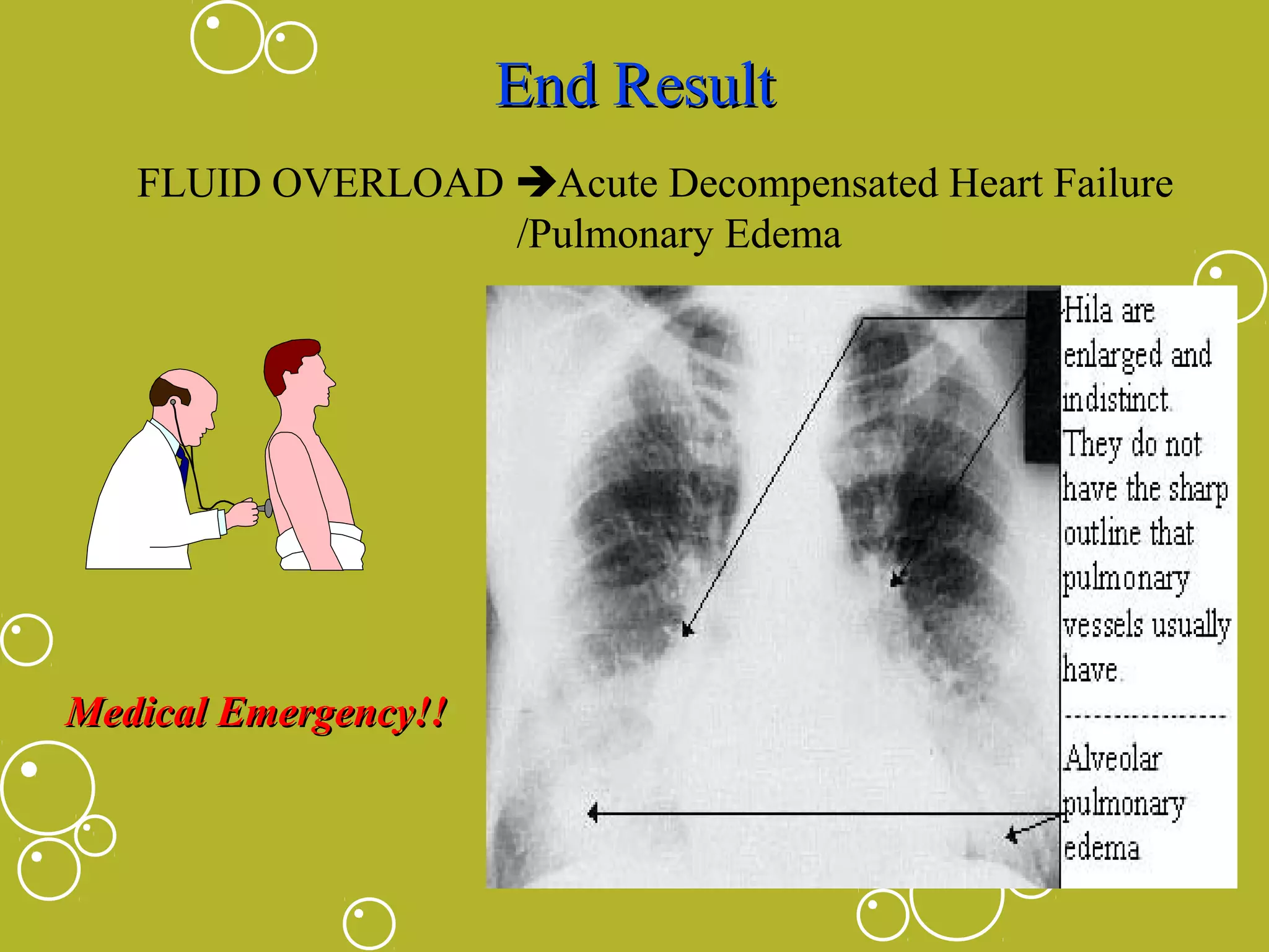 End Result
FLUID OVERLOAD Acute Decompensated Heart Failure
/Pulmonary Edema

Medical Emergency!!

 