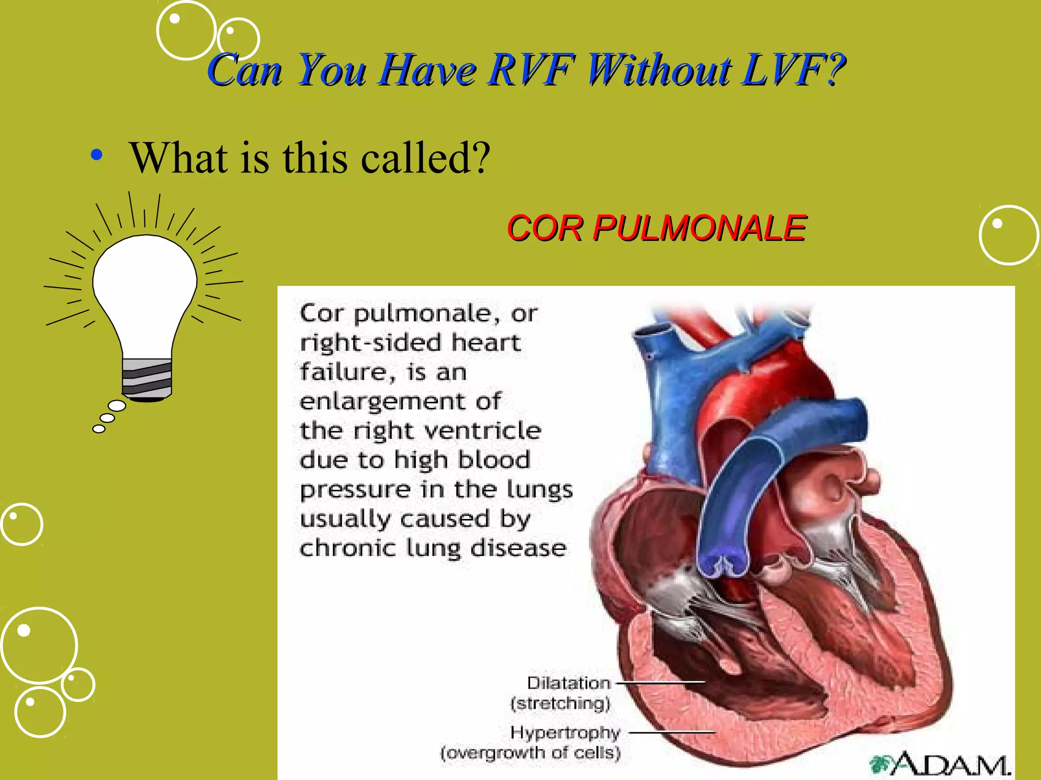Can You Have RVF Without LVF?
• What is this called?
COR PULMONALE

 