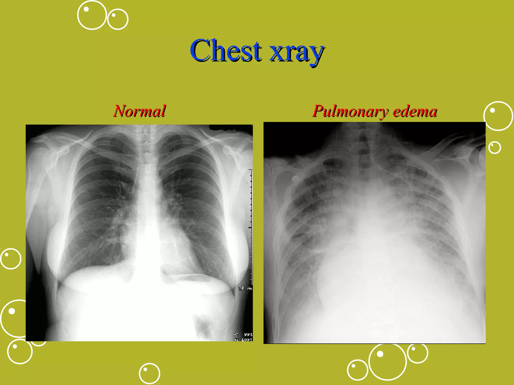 Chest xray
Normal

Pulmonary edema

 