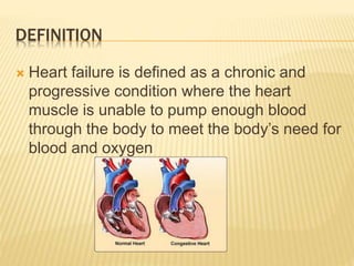 DEFINITION
 Heart failure is defined as a chronic and
progressive condition where the heart
muscle is unable to pump enough blood
through the body to meet the body’s need for
blood and oxygen
 