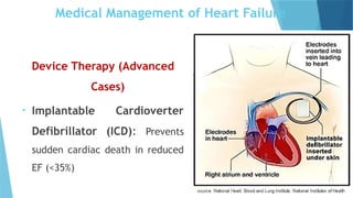 Device Therapy (Advanced
Cases)
• Implantable Cardioverter
Defibrillator (ICD): Prevents
sudden cardiac death in reduced
EF (<35%)
Medical Management of Heart Failure
 