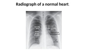 Radiology of Heart failure Presentation.pptx