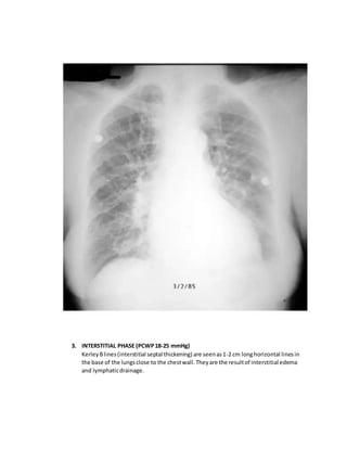 3. INTERSTITIAL PHASE (PCWP18-25 mmHg)
KerleyBlines(interstitial septal thickening) are seenas1-2 cm longhorizontal linesin
the base of the lungsclose to the chestwall. They are the resultof interstitial edema
and lymphaticdrainage.
 