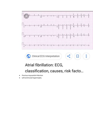  Previousmyocardial infarction
 Leftventricularhypertrophy
 