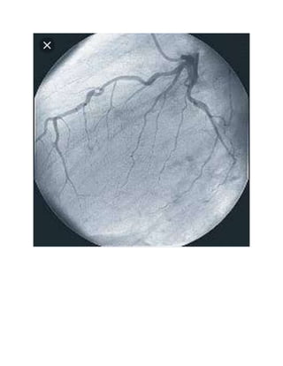 Heart failure radiology