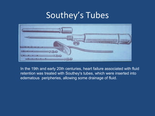 Southey’s Tubes




In the 19th and early 20th centuries, heart failure associated with fluid
retention was treated with Southey's tubes, which were inserted into
edematous peripheries, allowing some drainage of fluid.
 