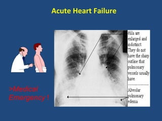 Acute Heart Failure




>Medical
Emergency !
 