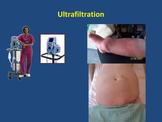 Ultrafiltration
 