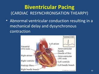 Biventricular Pacing
  (CARDIAC RESYNCHRONISATION THEARPY)
• Abnormal ventricular conduction resulting in a
  mechanical delay and dysynchronous
  contraction




                  Overview of Device Therapy   50
 