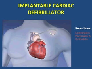 IMPLANTABLE CARDIAC
   DEFIBRILLATOR

                      Device Shown:
                      Combination
                      Pacemaker &
                      Defibrillator
 
