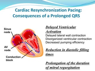 Cardiac Resynchronization Pacing:
Consequences of a Prolonged QRS
Delayed Ventricular
Activation
Delayed lateral wall contraction
Disorganized ventricular contraction
Decreased pumping efficiency
Reduction in diastolic filling
times
Prolongation of the duration
of mitral regurgitation
Sinus
node
AV
node
Conduction
block
 