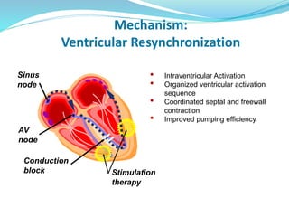 • Intraventricular Activation
• Organized ventricular activation
sequence
• Coordinated septal and freewall
contraction
• Improved pumping efficiency
Mechanism:
Ventricular Resynchronization
Sinus
node
AV
node
Stimulation
therapy
Conduction
block
 