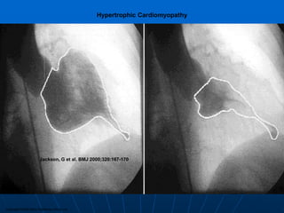 Copyright ©2000 BMJ Publishing Group Ltd.
Jackson, G et al. BMJ 2000;320:167-170
Hypertrophic Cardiomyopathy
 