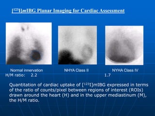 [123I]mIBG Planar Imaging for Cardiac Assessment
Normal innervation NHYA Class II NYHA Class IV
Quantitation of cardiac uptake of [123I]mIBG expressed in terms
of the ratio of counts/pixel between regions of interest (ROIs)
drawn around the heart (H) and in the upper mediastinum (M),
the H/M ratio.
H/M ratio: 2.2 1.7
 