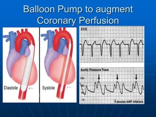 Balloon Pump to augment
Coronary Perfusion
 