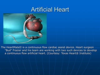 The HeartMateII is a continuous flow cardiac assist device. Heart surgeon
"Bud" Frazier and his team are working with two such devices to develop
a continuous flow artificial heart. (Courtesy: Texas Heart® Institute)
Artificial Heart
 