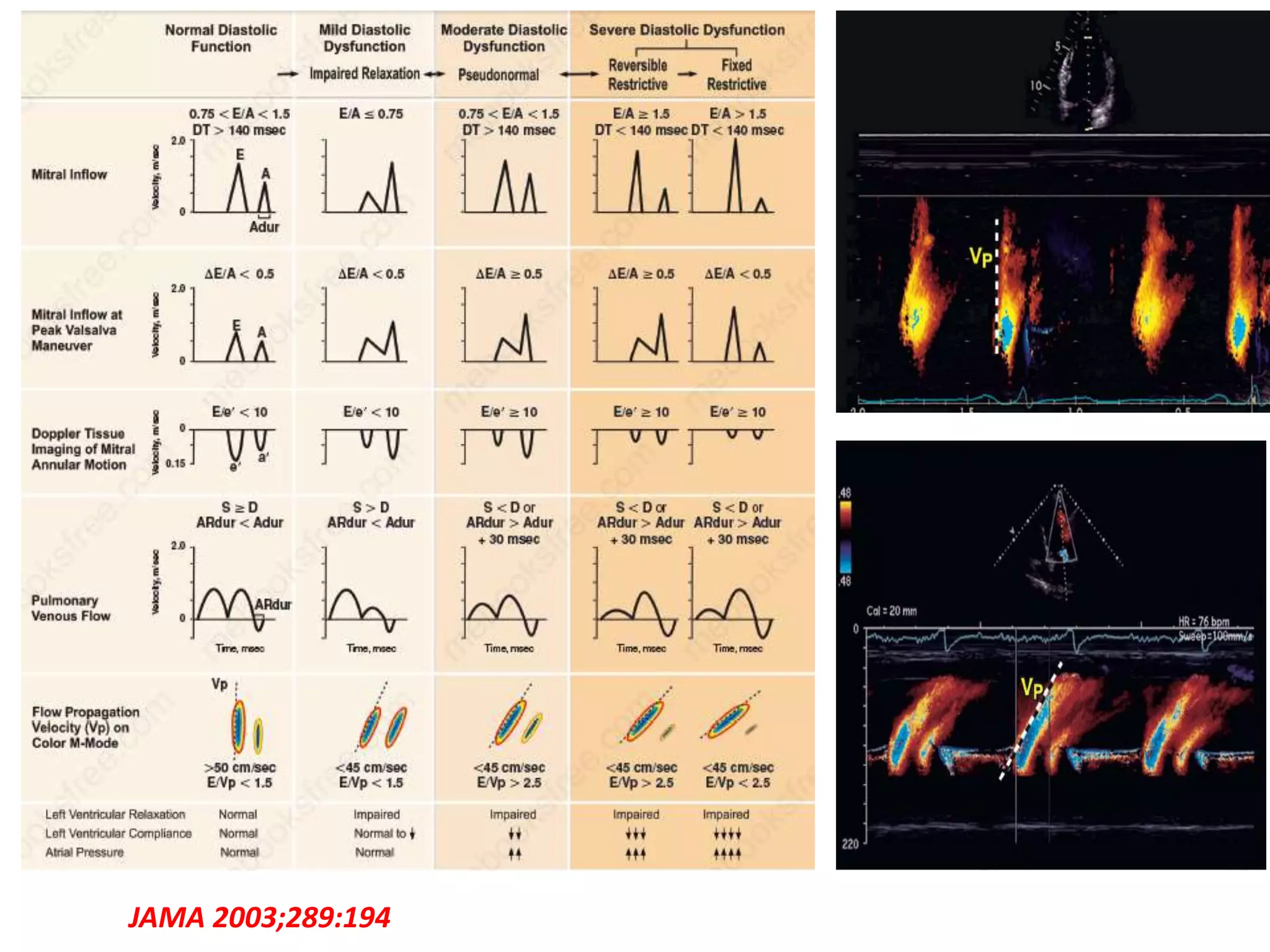 Heart failure with preserved ejection fraction | PPTX