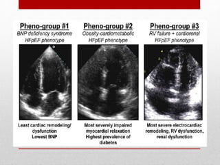 Heart failure with preserved ejection fraction | PPTX