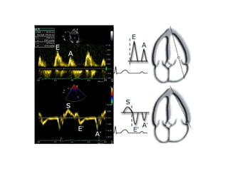 Heart failure with preserved ejection fraction dr oday abdow | PPTX