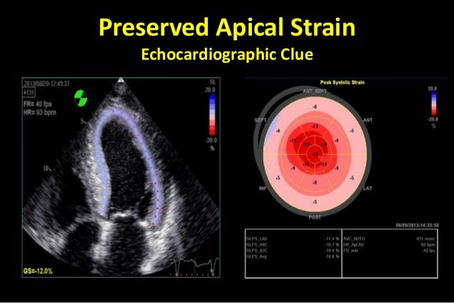 heart 2d test amyloidosis preserved senile lvef Heart with and failure heart 2d test amyloidosis preserved senile lvef Heart with and failure