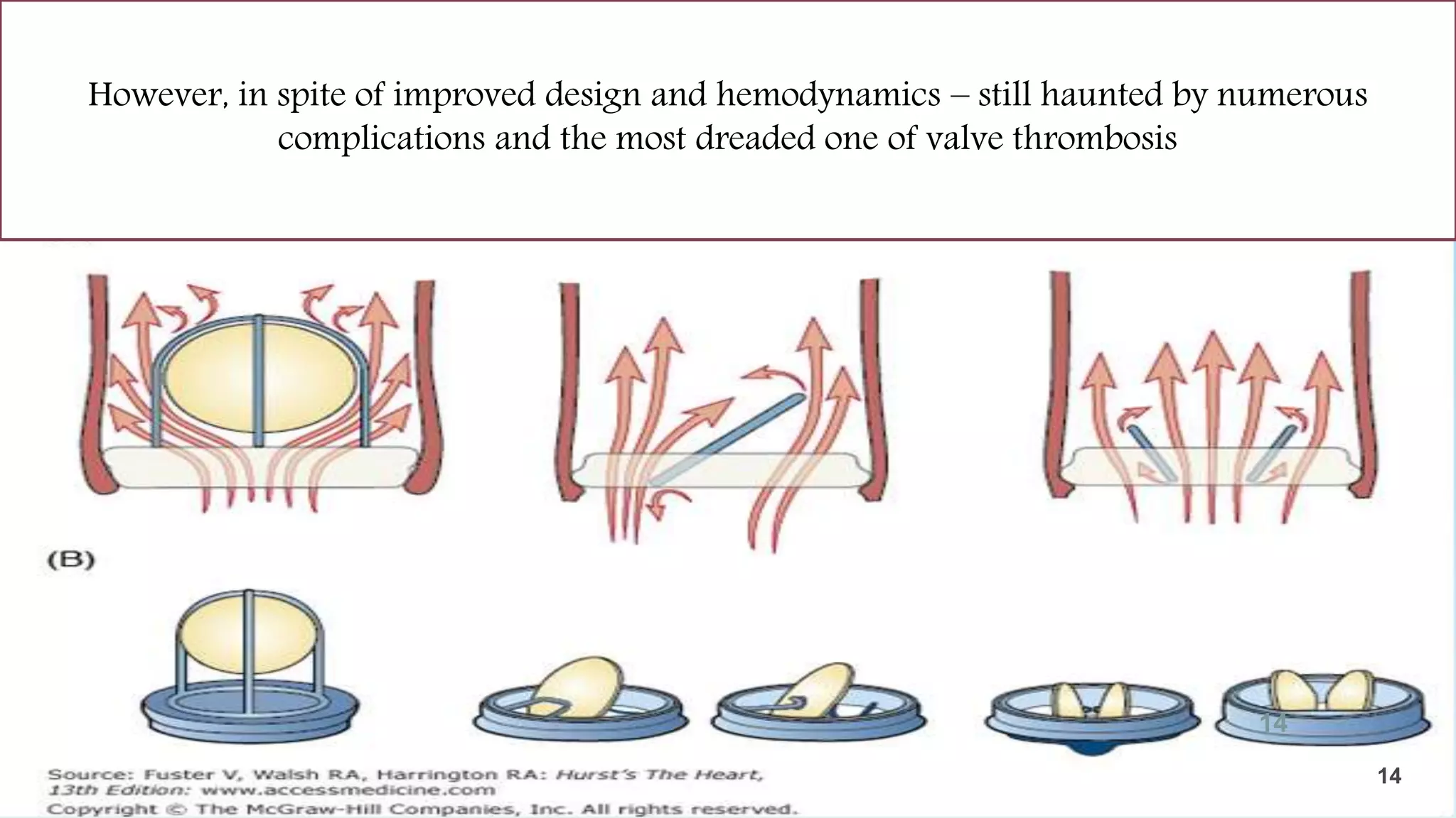 Hemodynamics of blood flow
However, in spite of improved design and hemodynamics – still haunted by numerous
complications and the most dreaded one of valve thrombosis
14
14
 