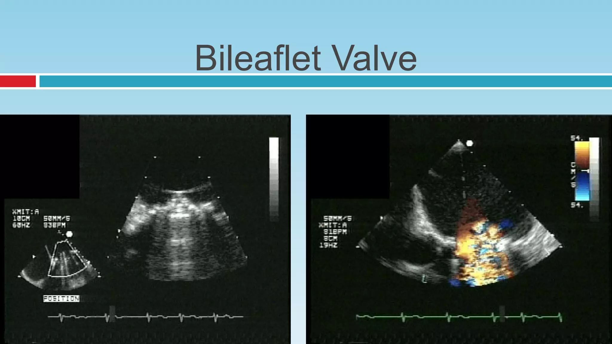 Bileaflet Valve
 