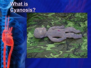 What is
Cyanosis?
 