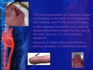• The blue discoloration of cyanosis is seen
  most readily in the beds of the fingernails
  and toenails, and on the lips and tongue.
• It often appears transiently as a result of
  slowed blood flow through the skin due to
  the cold. As such, it is not a serious
  symptom.
• However, in other cases cyanosis is a
  serious symptom of underlying disease.
 