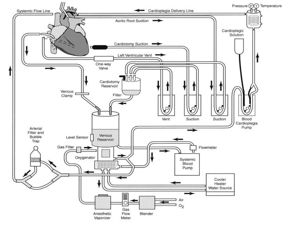 Heart lung machine also referred to as extracorporeal circulation...