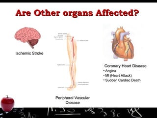 Are Other organs Affected? Ischemic Stroke Peripheral Vascular Disease Coronary Heart Disease Angina MI (Heart Attack) Sudden Cardiac Death 