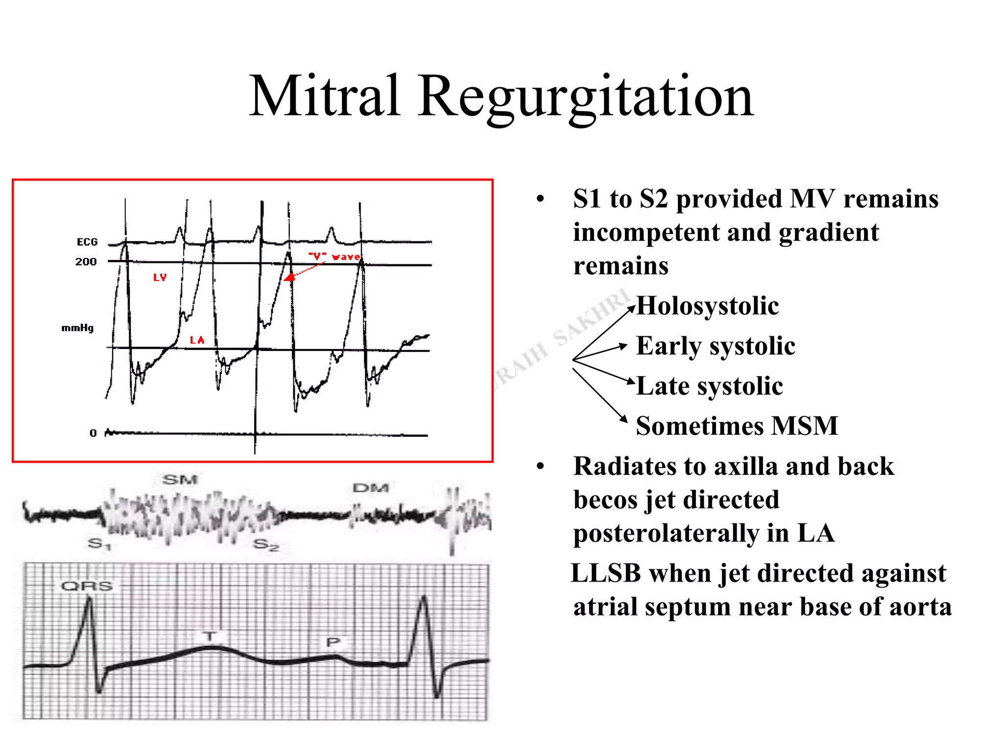 Mitral Regurgitation
• S1 to S2 provided MV remains
incompetent and gradient
remains
Holosystolic
Early systolic
Late systolic
Sometimes MSM
• Radiates to axilla and back
becos jet directed
posterolaterally in LA
LLSB when jet directed against
atrial septum near base of aorta
 