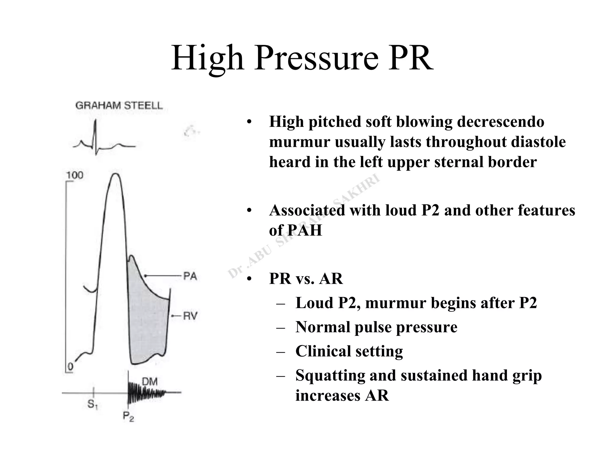 High Pressure PR
• High pitched soft blowing decrescendo
murmur usually lasts throughout diastole
heard in the left upper sternal border
• Associated with loud P2 and other features
of PAH
• PR vs. AR
– Loud P2, murmur begins after P2
– Normal pulse pressure
– Clinical setting
– Squatting and sustained hand grip
increases AR
 