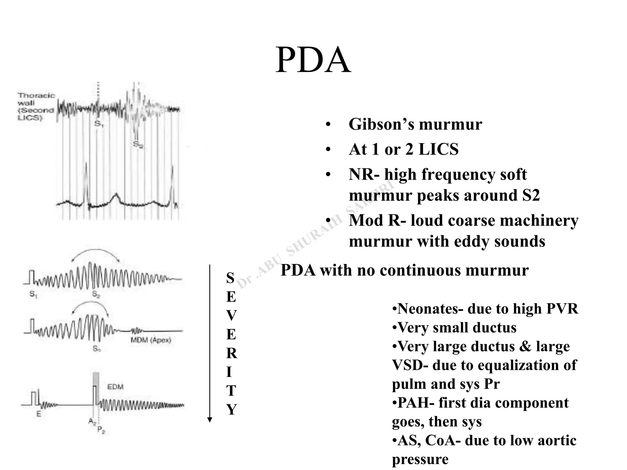 PDA
• Gibson’s murmur
• At 1 or 2 LICS
• NR- high frequency soft
murmur peaks around S2
• Mod R- loud coarse machinery
murmur with eddy sounds
S
E
V
E
R
I
T
Y
PDA with no continuous murmur
•Neonates- due to high PVR
•Very small ductus
•Very large ductus & large
VSD- due to equalization of
pulm and sys Pr
•PAH- first dia component
goes, then sys
•AS, CoA- due to low aortic
pressure
 