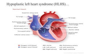Hypoplastic left heart syndrome (HLHS)…
 