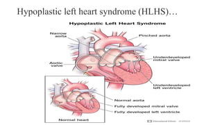 Hypoplastic left heart syndrome (HLHS)…
 