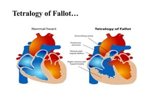 Tetralogy of Fallot…
 