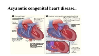 Acyanotic congenital heart disease..
 