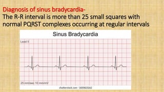 Diagnosis of sinus bradycardia-
The R-R interval is more than 25 small squares with
normal PQRST complexes occurring at regular intervals
 