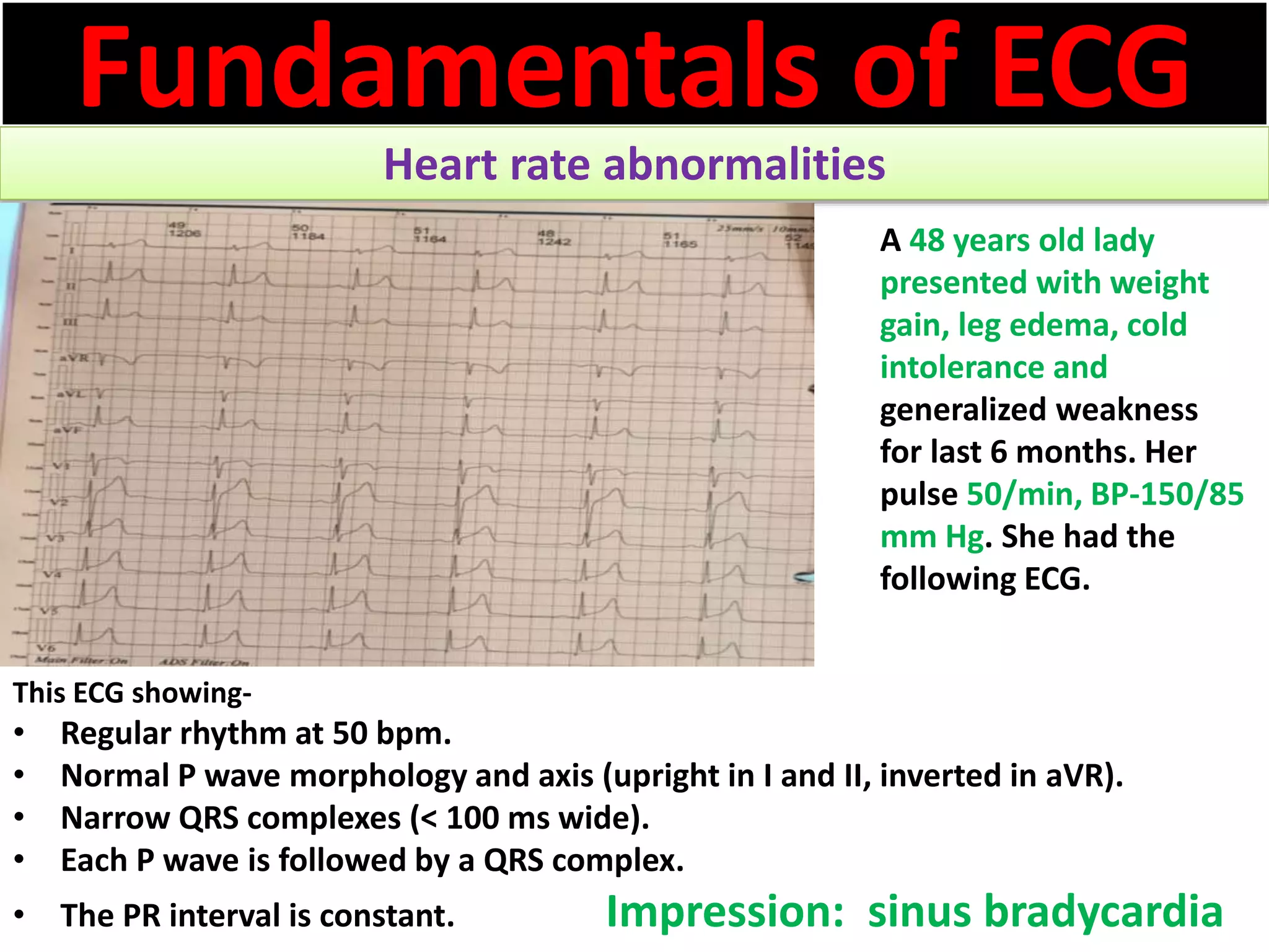 Approach to a patient with Heart rate abnormality in ECG | PPSX