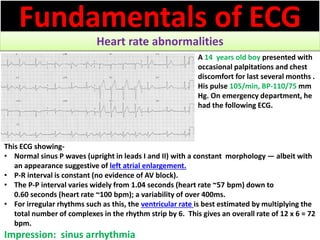 Approach to a patient with Heart rate abnormality in ECG | PPSX