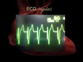 ECG  (regular)   