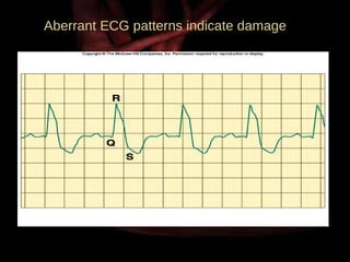 Aberrant ECG patterns indicate damage 