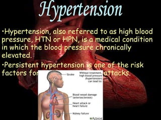 Hypertension, also referred to as high blood pressure, HTN or HPN, is a medical condition in which the blood pressure chronically elevated. Persistent hypertension is one of the risk factors for strokes and heart attacks . Hypertension 