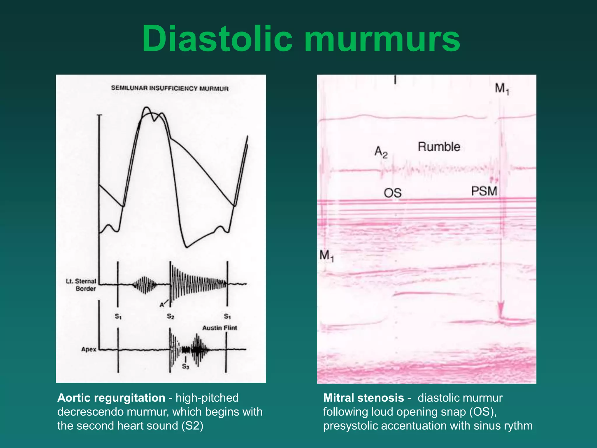 Heart sound auscultation.ppt