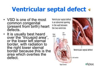 Ventricular septal defect VSD is one of the most common congenital (present from birth) heart defects. It is usually best heard over the “tricuspid area”, or the lower left sternal border, with radiation to the right lower sternal border because this is the area which overlies the defect.  