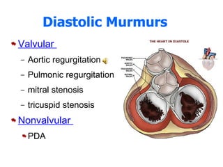 Diastolic Murmurs   Valvular  Aortic regurgitation Pulmonic regurgitation mitral stenosis tricuspid stenosis Nonvalvular  PDA 
