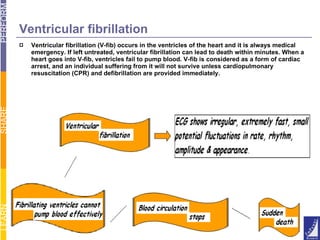 Ventricular fibrillation Ventricular fibrillation (V-fib) occurs in the ventricles of the heart and it is always medical emergency. If left untreated, ventricular fibrillation can lead to death within minutes. When a heart goes into V-fib, ventricles fail to pump blood. V-fib is considered as a form of cardiac arrest, and an individual suffering from it will not survive unless cardiopulmonary resuscitation (CPR) and defibrillation are provided immediately. 