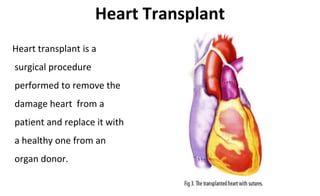 Heart Transplant
Heart transplant is a
surgical procedure
performed to remove the
damage heart from a
patient and replace it with
a healthy one from an
organ donor.
 