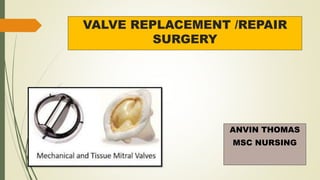 VALVE REPLACEMENT /REPAIR
SURGERY
ANVIN THOMAS
MSC NURSING
 