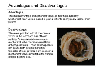 Advantages and Disadvantages 
Advantages 
The main advantage of mechanical valves is their high durability. 
Mechanical heart valves placed in young patients can typically last for their 
lifetime 
Disadvantages 
The major problem with all mechanical 
valves is the increased risk of blood 
clotting. As a preventative measure, 
mechanical valve recipients must take 
anticoagulantants. These anticoagulants 
can cause birth defects in the first 
trimester of fetal development, rendering 
mechanical valves unsuitable for women 
of child-bearing age. 
 